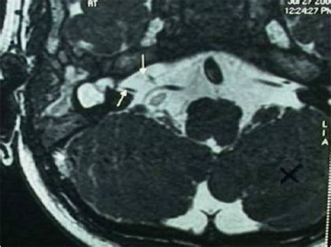 Fig2: MRI brain showing an absent vestibulocochlear nerve complex on ...