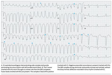 Ecg Diagnosis Of Wide Complex Tachycardia Journalfeed