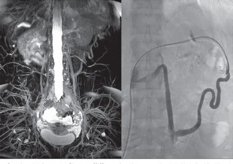 Figure 1 From Evaluation Of Effectiveness Of Endovascular Embolisation