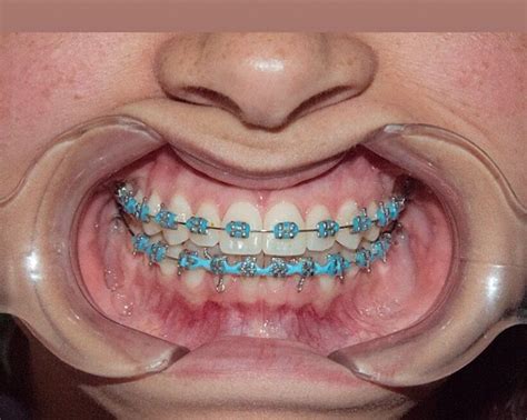 Dental Braces Colors Cute Braces Colors Dark Blue Braces Down