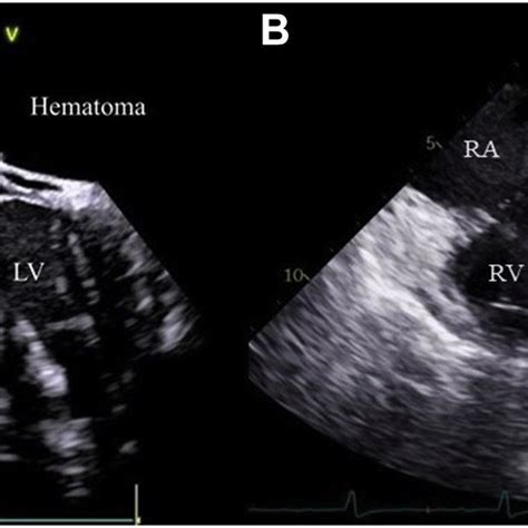 Two Dimensional TEE Midesophageal Aortic Valve Long Axis View Before