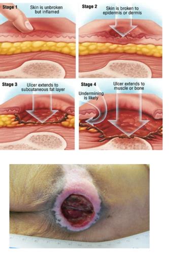 Surgery L Wound Healing Repair Flashcards Quizlet