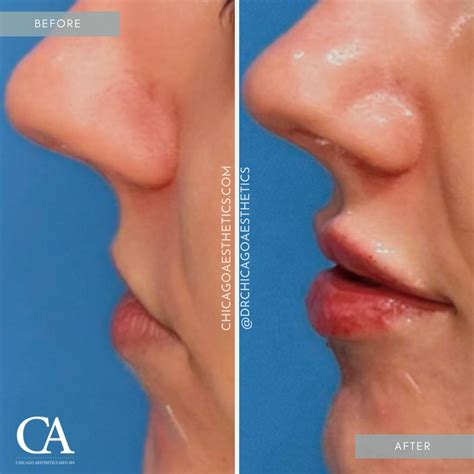 Lip Injections Before After Chicago Aesthetics Medspa