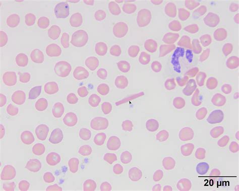 Hemoglobin Crystal Eclinpath