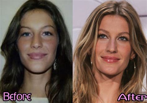 Gisele Bundchen Nose Job Plastic Surgery Before And After