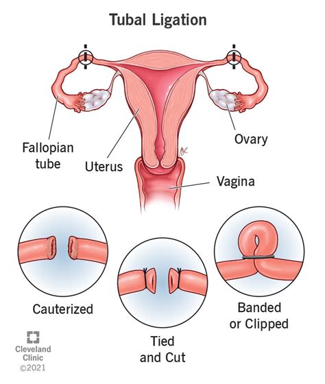 Tubal Ligation: Procedure, Recovery & Side Effects