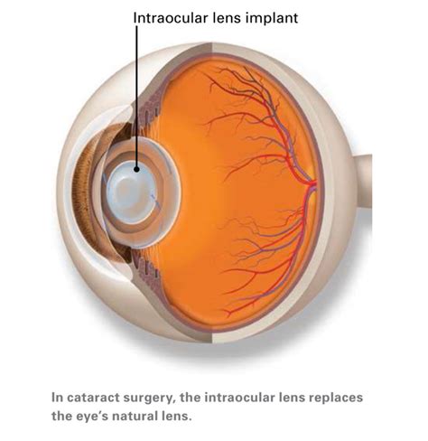 No Gap Cataract Surgery Strathfield Eye Surgery