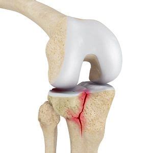 Tibial Plateau Fracture Brigham City Ut Knee Joint Pain Knee