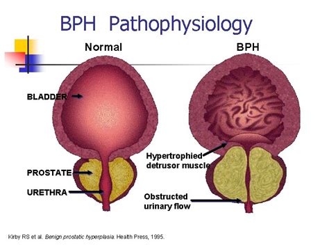 Benign Prostatic Hyperplasia Benign Prostatic Hyperplasia N 11242020