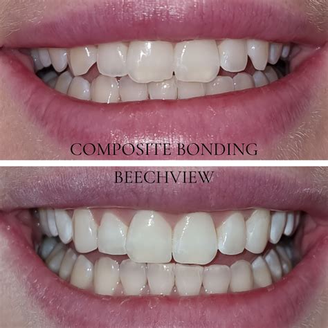 Composite Bonding Dental Bonding Teeth Bonding Beechview Dental