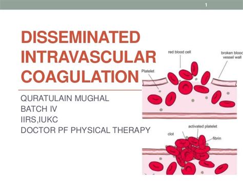 Disseminated Intravascular Coagulation