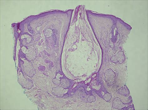 Multiple Facial White Papules—diagnosis Dermatology Jama