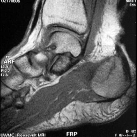 Stress fracture MRI - wikidoc