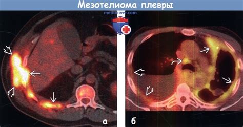 Диагностика мезотелиомы плевры на рентгене, КТ, МРТ