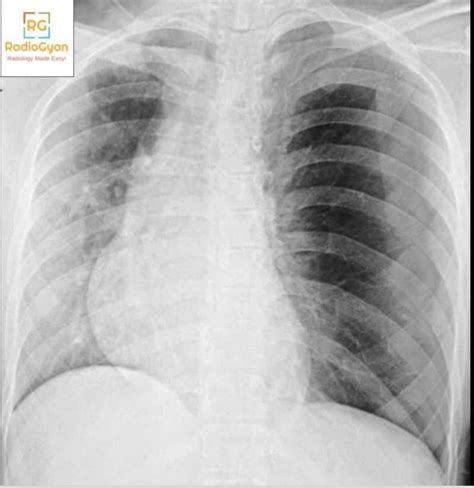 Aunt Minnie Chest Radiology Cases Spotters Set 33 RadioGyan