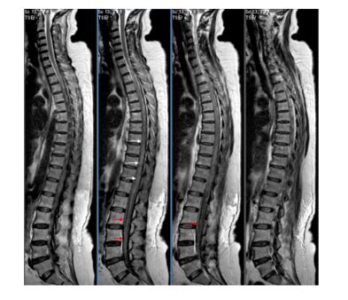 Primary Spinal Cord Haemorrhage During COVID 19 Illness A Novel