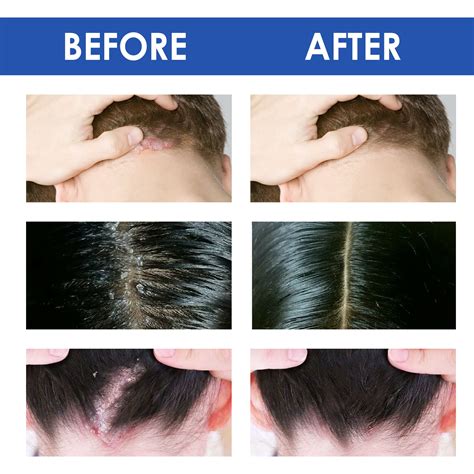 Buy Seborrheic Dermatitis Cream Psoriasis Scalp Treatment