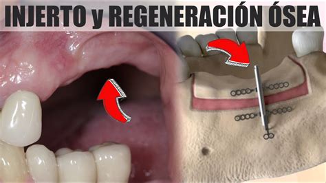 Regeneraci N Sea E Injerto Implante Dental En Poco Hueso Maxilar