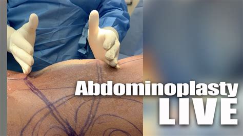 Live Abdominoplasty Procedure YouTube