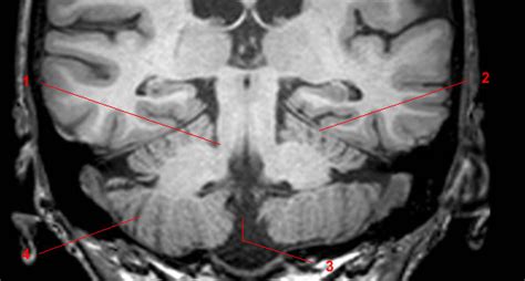 Cerebellum - W-Radiology