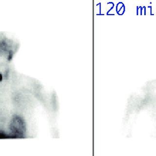 Single Isotope Dual Phase Scintigraphy With M Tc Sestamibi In A