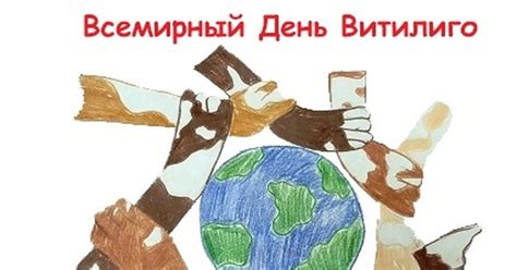 Всемирный день Витилиго | Пикабу