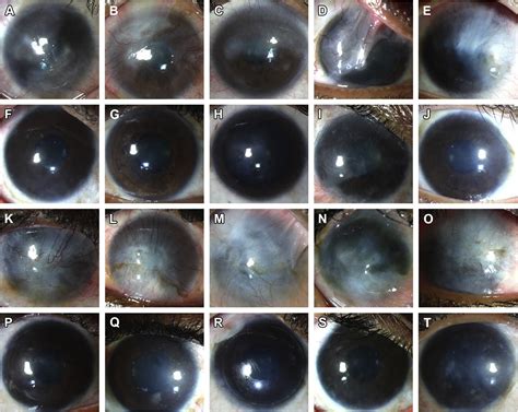 Simple Limbal Epithelial Transplantation Ophthalmology