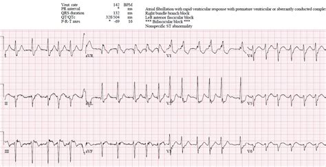 EM Cases | ECG cases 12: RBBB + Occlusion MI