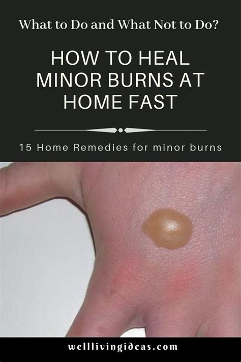 How To Treat A First Degree Minor Burn With Home Remedies Burns