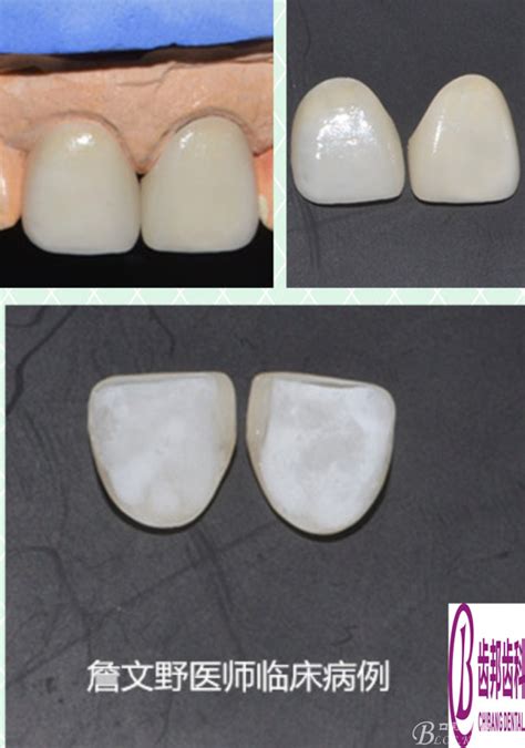 前牙全瓷超薄贴面修复两例 詹文野的博客 Kq88口腔博客