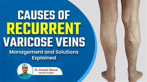 Prevent Varicose Veins From Recurring Tips And Techniques By Dr