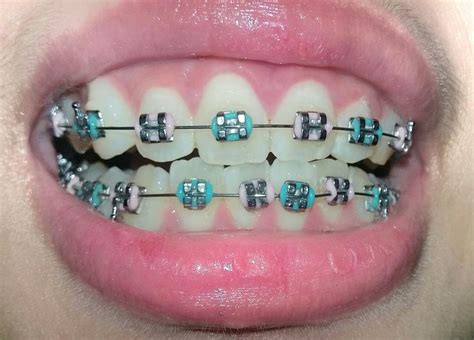 Pastel Color Braces Light Blue And Pink Dental Braces Colors Pink