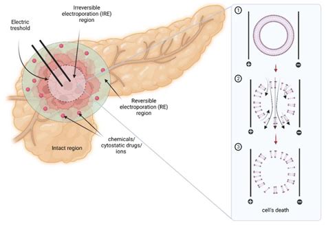 Ijms Free Full Text Irreversible Electroporation In Pancreatic