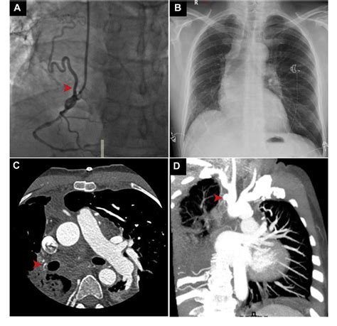 Figure From Images In Cardiology Double Trouble Ductal Origin Of