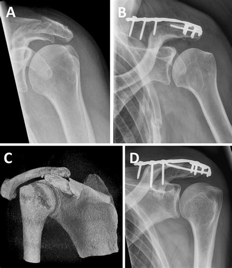 Pre And Postoperative Radiographs Of Patient A B And Patient C