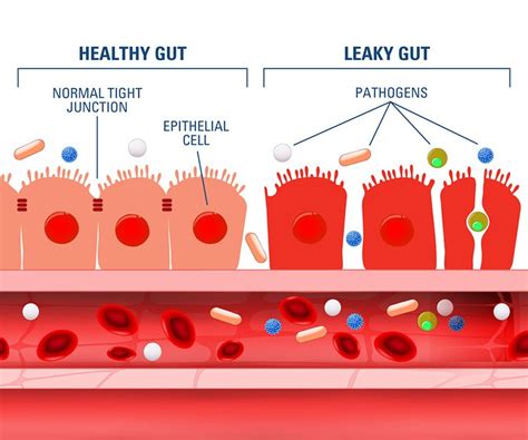 Leaky Gut Testing Consult Dr Hagmeyer