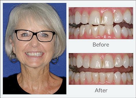 Invisalign Dental Excellence