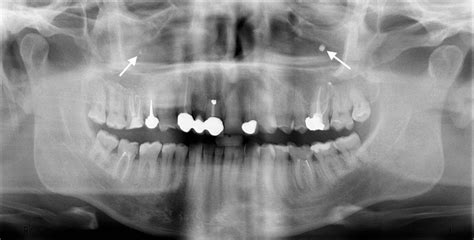 Unusual Case Of Bilateral Maxillary Fungus Ball Bmj Case Reports