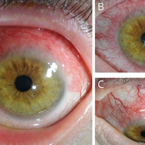 Appearance Of Limbal Inflammation In Patients With Dupilumab Associated