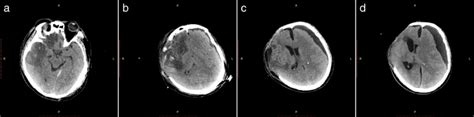 Brain Ct Scan Before And After Decompressive Craniectomy A Brain Ct