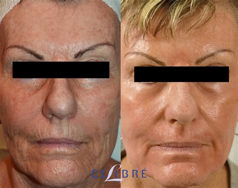 Juvederm For Smokers Lines Before And After