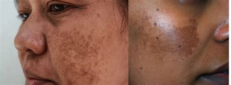 Understanding Melasma Causes Symptoms Diagnosis And Treatments All