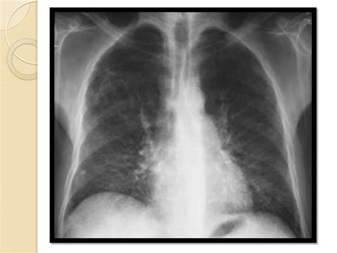 Toxicidad Pulmonar Por Quimio Terapia Ppt Descarga Gratuita