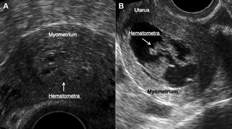 Cause Or Coincidence Spontaneous Hematometra In Young Women Receiving