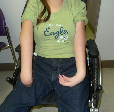 Arthrogryposis Congenital Hand And Arm Differences Washington