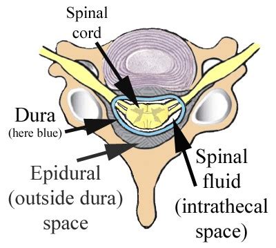 Epidural Steroids – Risk vs Benefit | Spinal CSF Leak Foundation