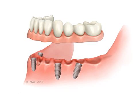 False Teeth Denture Alternatives Implant Supported Complete Arch Bridge