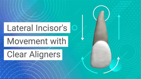 Lateral Incisors Movement With Clear Aligners Youtube