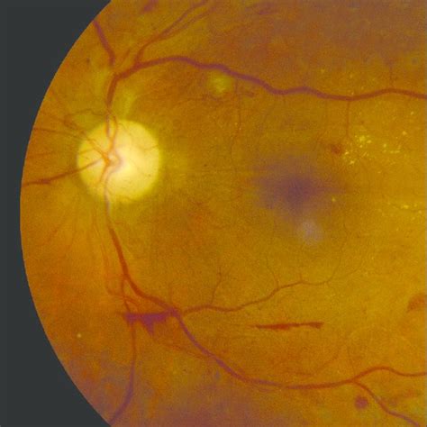 Fundus Photography Demonstrating Proliferative Diabetic Retinopathy