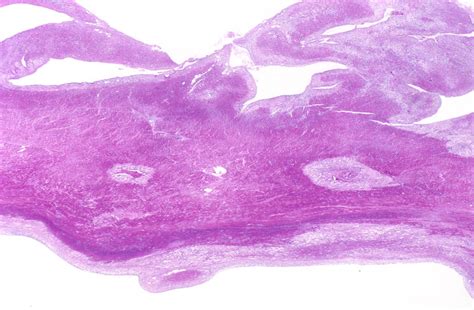 ST Elevation Myocardial Infarction Histopathology Wikidoc